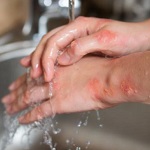 Imagen Qué hacer frente a lesiones por quemaduras