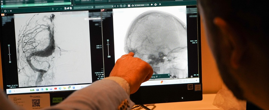 Imagen Usaron nuevo agente para malformaciones venosas del cerebro